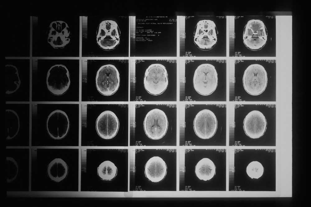 Présentation de clichés IRM du cerveau pour sclérose en plaques
