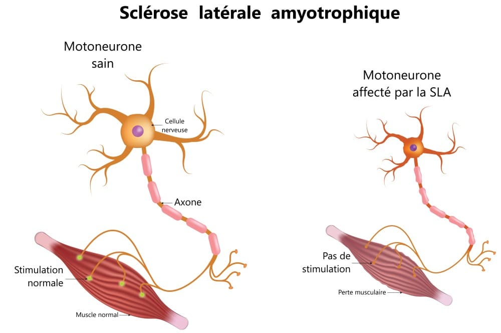 Schéma dans la sclérose latérale amyotrophique dit SLA