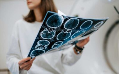 Moelle épinière cancer : Symptômes, causes, espérance de vie