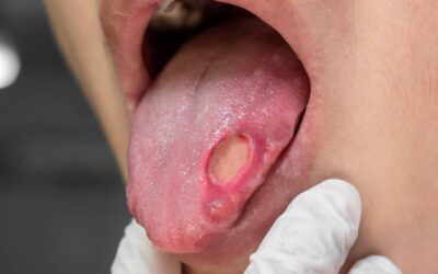 Maladie de Behçet : Espérance de vie, symptômes, photo