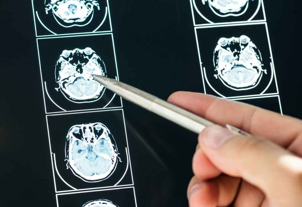 Peut-on vivre longtemps avec une tumeur au cerveau