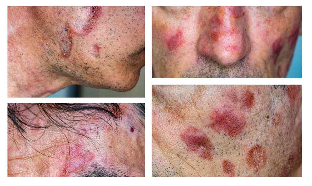 Lupus érythémateux : disséminé, systémique, cutané