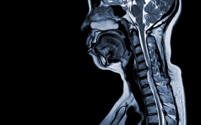 Compression médullaire : Peut-on marcher, symptômes et causes