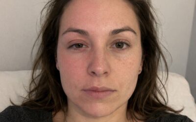 Tout savoir sur le syndrome d&rsquo;Harlequin et ses causes