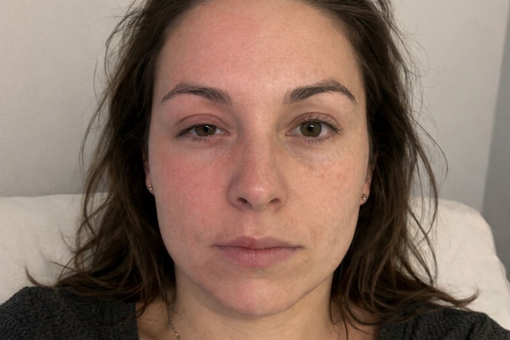 Syndrome d'Harlequin, moitié du visage rouge