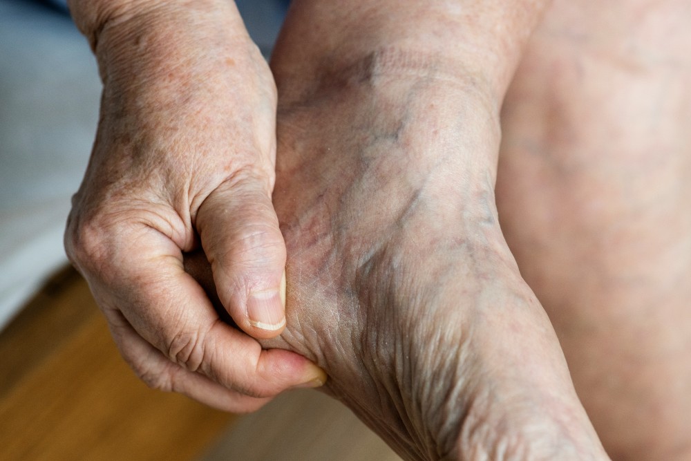 Personne se tenant le pied neuropathie des petites fibres