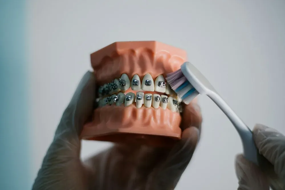 Modèle dentaire avec appareil orthodontique servant à illustrer les zones à nettoyer